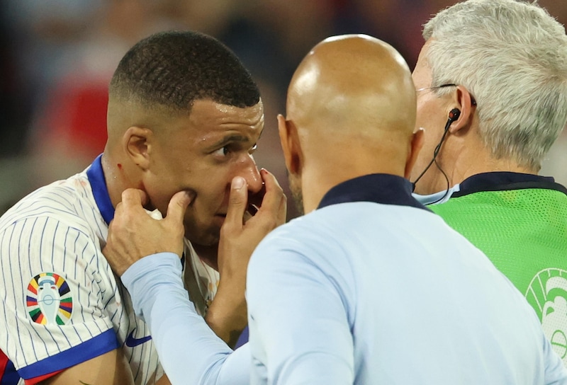 Mbappé shock: frattura al naso, si deve operare! Quante partite può saltare