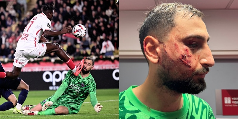 Donnarumma ko: tremendo scontro con Singo, sangue e ferite sul volto