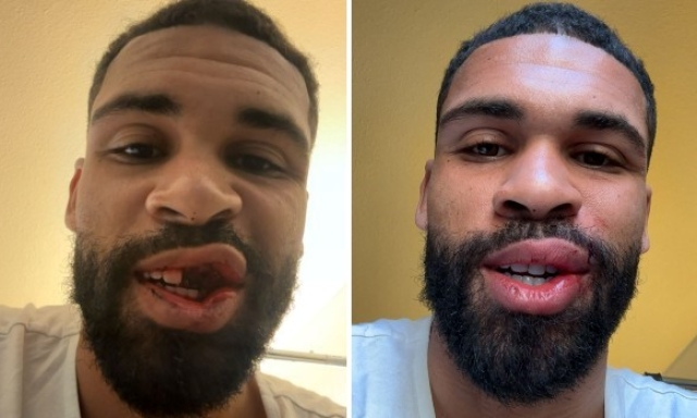 Loftus-Cheek: foto impressionanti, ma operazione ai denti riuscita. Tornerà in campo tra due mesi